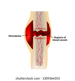 1 Stage Of Healing Bone Fracture. Formation of callus. Hematoma. The bone fracture. Infographics. Vector illustration on isolated background.