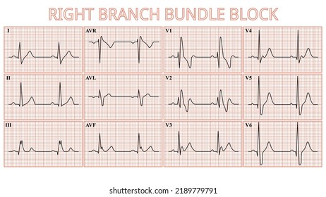 12 Lead ECG - Right Bundle Branch Block