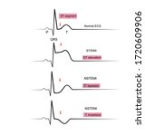 The 1-lead ECG in STEMI(ST Elevation Myocardial Infraction and NSTEMI(Non ST Elevation Myocardial , Electrocardiographic Diagnosis criteria 