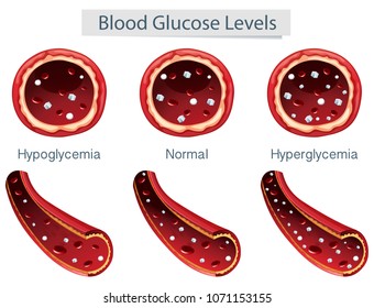 3 Different Blood Glucose Levels Illustration