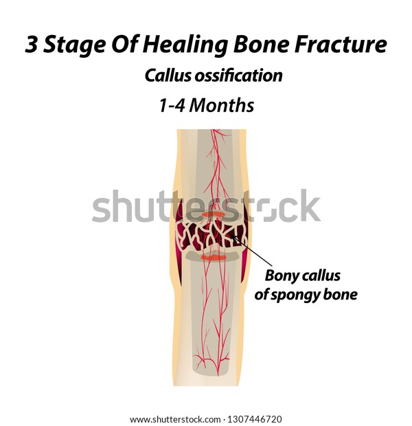 3 Stage Of Healing Bone Fracture. callus\
ossification. The bone fracture. Infographics. Vector illustration\
on isolated background.