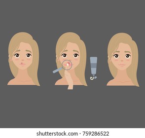 3 steps how to examine and apply anti herpes lip cream. Young blonde girl in spa beauty tutorial. Skincare. Vector isolated illustrations set.