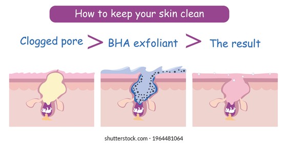 3 steps vector infographic how to clean up clogged pores using bha salicylic cleanser exfoliant for pure skin care routine. Cosmetic dermatological process scheme. Dermal layer explained anatomy. 