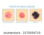 3 Types of skin cancer. Illustration about medical diagram of basal cell carcinoma, squamous cell carcinoma, and Melanoma for diagnosis and treatment of skin lesions.
