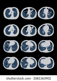 3D Covid-19 Computed Tomography Of The Lungs With Pneumonia. CT Scan. Coronavirus Disease Examination In High Resolution. EPS10 Vector