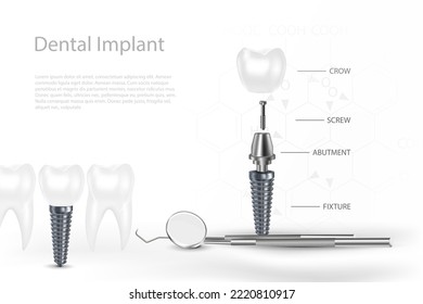 3D Dental Implants Surgery Concept with Tool