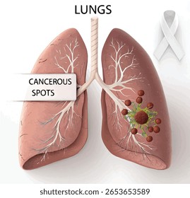 3d human lungs cancerous spots