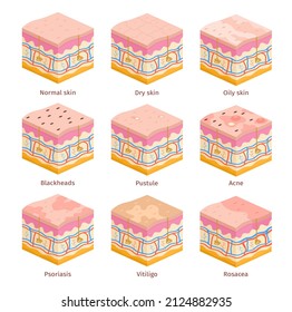 3d Human Skin Types Cross Section Layers. Dry, Oily And Normal Epidermis. Skin Problems, Acne, Blackheads, Psoriasis And Vitiligo Vector Set. Illustration Of Medical Dermatology Epidermis