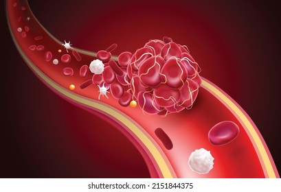 3D illustration of a blood clot in a blood vessel showing a blocked blood flow with platelets and white blood cells in the image. medical use education and science