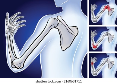 3D illustration of bone from scapula to fingertip showing the location of three pain points on a dark blue background. It is used in medicine, education and science.