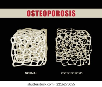 Ilustración 3D que compara la osteoporosis con el hueso normal en el fondo negro. uso médico Educación y comercio