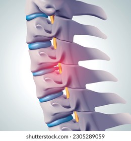 3D illustration. Herniated discs press on nerves causing pain. Medical, educational and scientific use