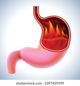 3D illustration of a stomach with flames burning inside is a sign of burning pain, a symptom of gastritis. cut open to see inside For medical, educational, industrial and scientific use