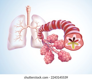 3D illustration of trachea and air sacs in human lungs highlighting bronchitis and filled with phlegm. Medical, educational and commercial use