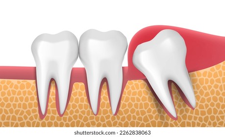 3D Infographics With A Wisdom Tooth Problem. EPS10 Vector