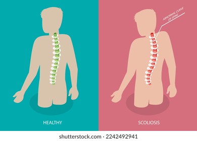 3D Isometric Flat Vector Conceptual Illustration of Scoliosis, Normal Spine and One with Defects