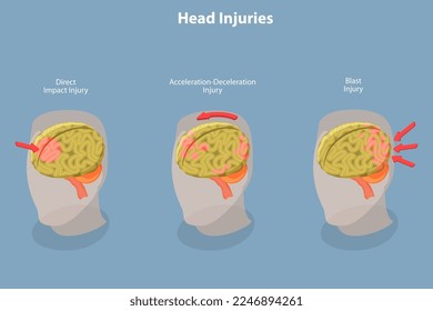 3D Isometric Flat Vector Conceptual Illustration of Brain Injuries, Head Trauma Scheme