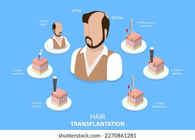 3D Isometric Flat Vector Conceptual Illustration of Hair Transplantation, Stages of FUE Procedure