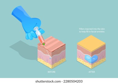 Vector plano isométrico 3D Ilustración conceptual del llenado cosmético inyectable, inyección antiarrugas