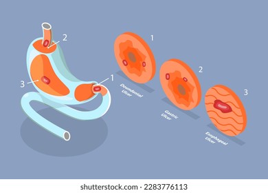 Ilustración conceptual del vector plano isométrico 3D de la enfermedad del estómago de úlcera péptica, gastritis e inflamación