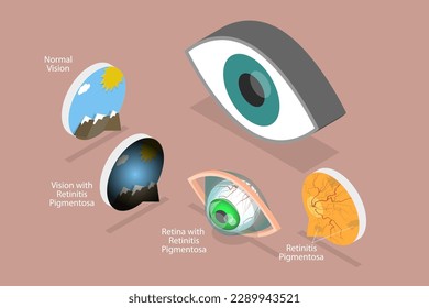Ilustración conceptual del vector plano isométrico 3D de la visión de degeneración retiniana, degeneración macular relacionada con la edad