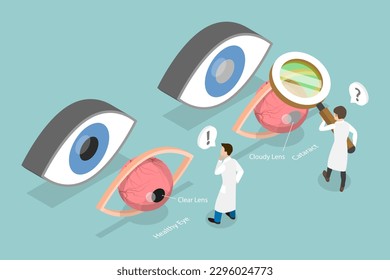 3D Isometric Flat Vector Conceptual Illustration of Cataract, Ophthalmology, Eye Surgery