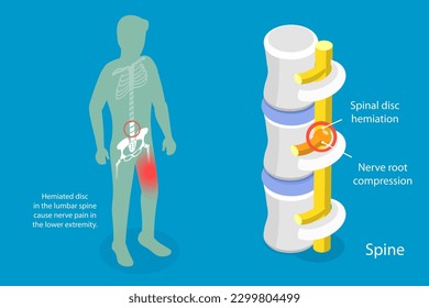 3D Isometric Flat Vector Conceptual Illustration of Sciatica Nerve Pain, Disc Degeneration