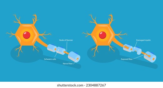 3D Isometric Flat Vector Conceptual Illustration of Multiple Sclerosis, Demyelinating Disease