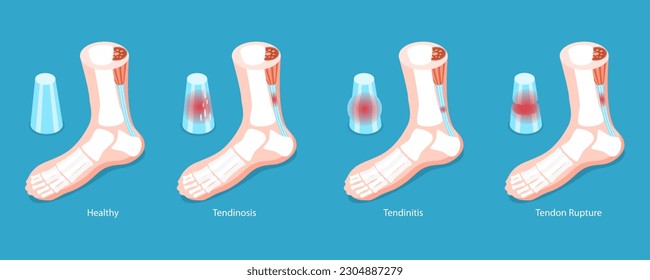 3D Isometric Flat Vector Conceptual Illustration of Achilles Tendon, Tendinitis Problem