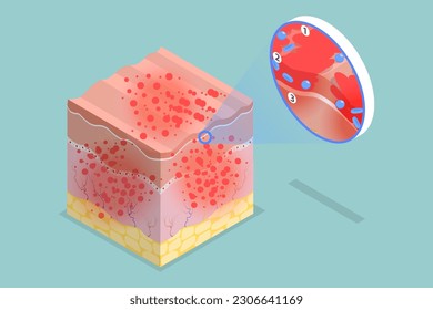 3D Isometrischer flacher Vektor Conceptual Illustration Atopic Dermatitis, Ekzemsymptome