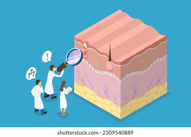 3D Isometric Flat Vector Conceptual Illustration of Acne Vulgari, Formation of Skin Pimple