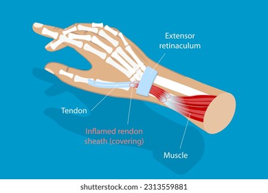 Ilustración conceptual del síndrome de De Quervain, enfermedad ocupacional de la mano por un vector plano isométrico 3D