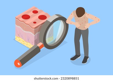 3D Isometric Flat Vector Conceptual Illustration of Chickenpox, Red Rash