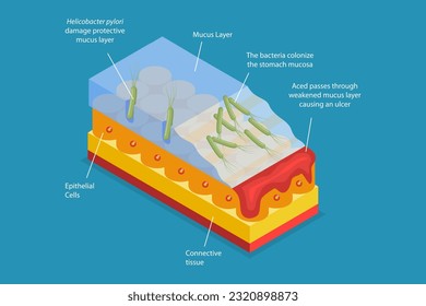 3D Isometric Flat Vector Conceptual Illustration of Peptic Ulcer, Digestive Tract Disorder