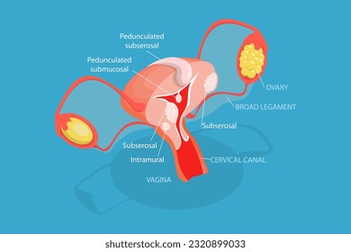 3D Isometric Flat Vector Conceptual Illustration of Types Of Uterine Fibroids, Human Anatomy