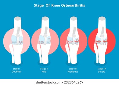3D Isometric Flat Vector Conceptual Illustration of Stage Of Knee Osteoarthritis, Anatomy of Leg Joints
