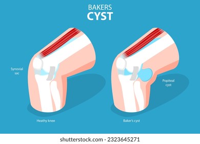 3D Isometric Flat Vector Conceptual Illustration of Bakers CYST, Traumatology and Prthopedics