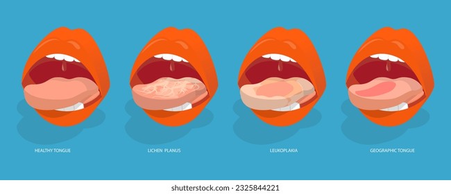 3D Isometric Flat Vector Conceptual Illustration of Sore Or White Tongue, Definition of the Disease by Tongue