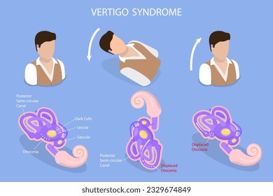 3D Isometric Flat Vector Conceptual Illustration of Vertigo Syndrome , BPPV