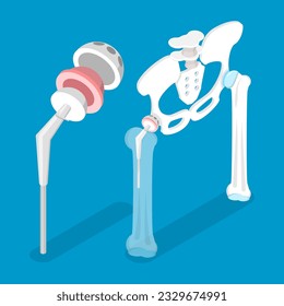 3D Isometric Flat Vector Conceptual Illustration of Total Hip Replacement, Joint Implant