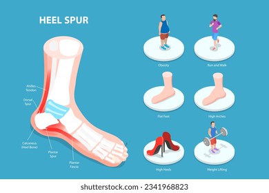 3D Isometric Flat Vector Conceptual Illustration of Heel Spur, Calcaneal Bone Condition