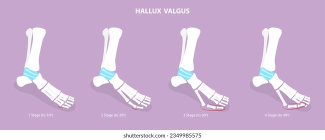 3D Isometric Flat Vector Conceptual Illustration of Hallux Valgus, Bunion in Foot