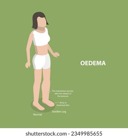 3D Isometric Flat Vector Conceptual Illustration of Oedema, Swollen Ankles and Feet