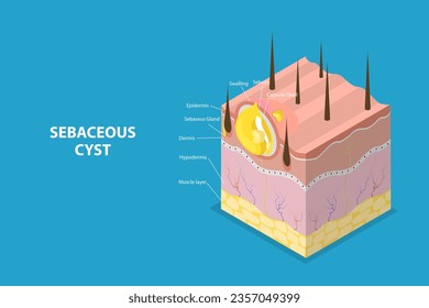 3D Isometric Flat Vector Conceptual Illustration of Sebaceous Cyst