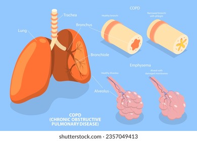 3D Isometric Flat Vector Conceptual Illustration of COPD