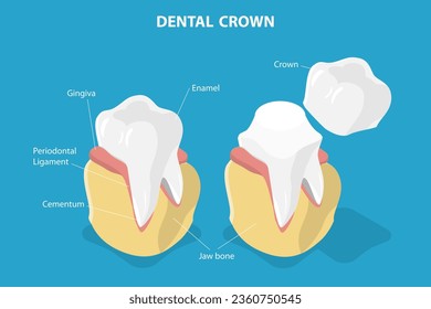 3D Isometric Flat Vector Conceptual Illustration of Dental Crown Restoration