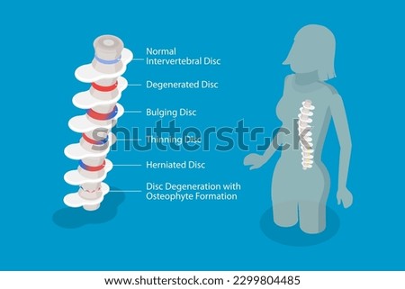 3D Isometric Flat Vector Conceptual Illustration of Degenerative Disc Disease, Educational Medical Schema