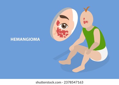 3D Isometric Flat Vector Illustration of Hemangioma