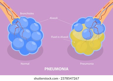 Vector plano isométrico 3D Ilustración de neumonía