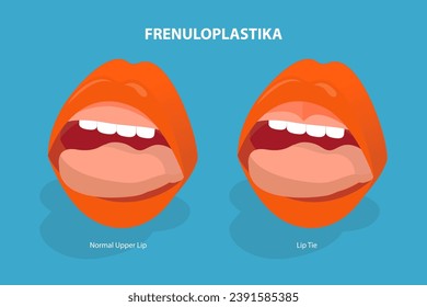 3D Isometric Flat Vector Illustration of Frenuloplastika